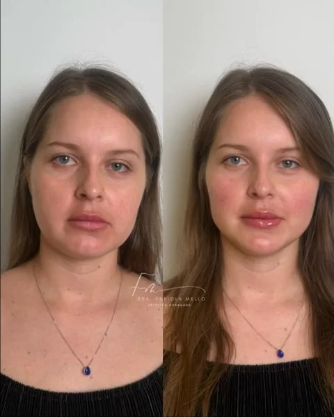 Antes e depois de harmonização facial, vista frontal