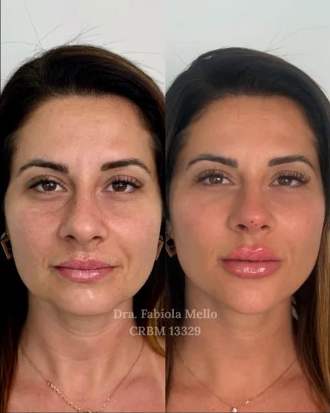 Antes e depois de harmonização full face
