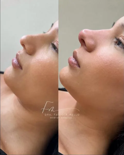 Antes e depois de técnica FaceCode, vista lateral